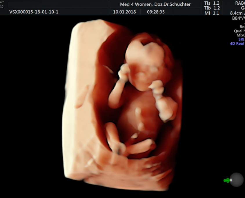 3D-Ultraschall bei med4women – dreidimensionaler Ultraschall